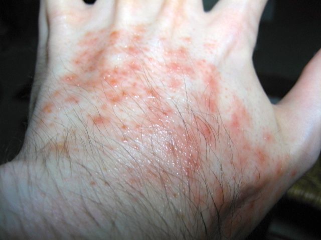 Rash : Check Your Symptoms and Signs – MedicineNet